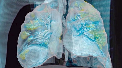 The coronavirus wreaked extensive damage (yellow) on the lungs of a 59-year-old man who died at George Washington University Hospital, as seen in a 3D model based on computerized tomograph scans. [Credit: George Washington Hospital and Surgical Theatre, 2020]